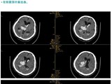 4天收治8位脑出血患者！天气渐寒，要学会这些预防→