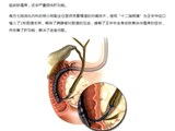 告别“癌痛”，一“针”见效： 超声内镜引导下腹腔神节阻滞术（EUS-CPN）