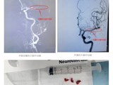 中风的救治重在“速度”！我院成功救治94岁高龄脑卒中老人