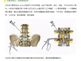 老年下肢麻木走不远“无得医”？NO！两个小孔让患者喜开颜