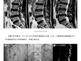 脊柱微创技术！南方七院脊柱外科开展单侧双通道内镜手术（UBE）