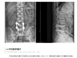 “镜”上添花丨我院成功开展开放式脊柱内镜下（OSE）腰椎融合手术