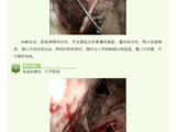包裹性脓胸不一定要“胸膜剥脱”，南方七院呼吸内科运用胸腔镜融合技术解病痛